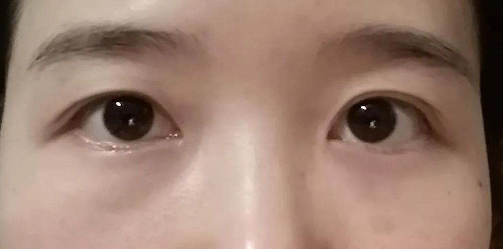 提升变美不可兼得?和射频提升相比,传统拉皮手术对面部有哪些影响?