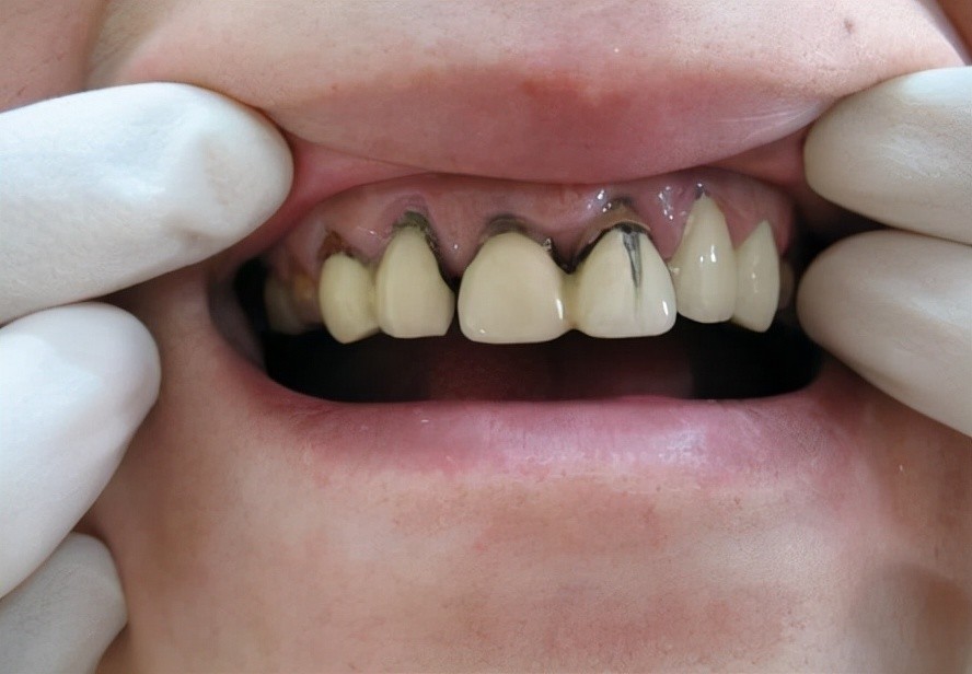 2,消除牙龈黑线,防止牙龈萎
