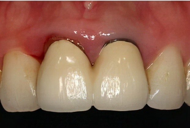 2,不良修复体:若选择的烤瓷牙材料不好,生物相容性差的话,会对牙龈