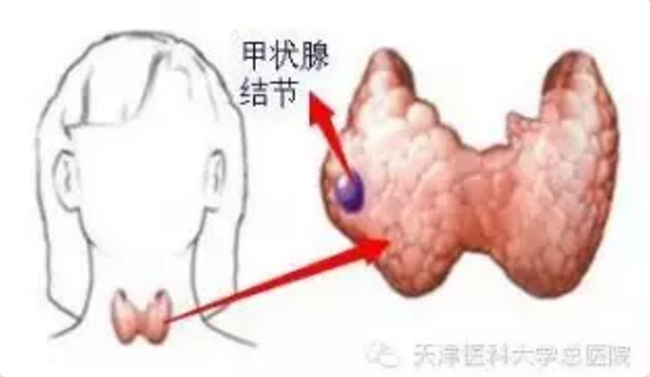 三,其它区别:不管是甲状腺结节或是甲状腺囊肿,都可以是单个或多个