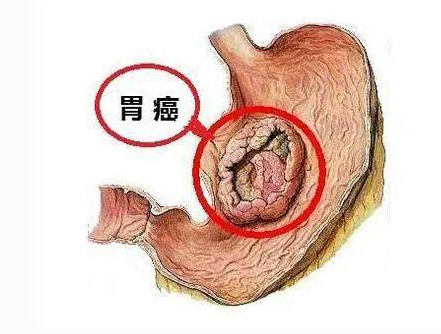 多大的胃息肉会引起胃癌?