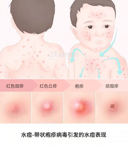 水痘高发期已