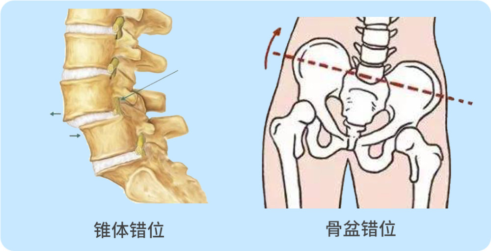 2. 脊柱,骨盆出现错位