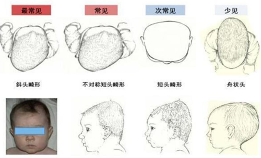 龙凤胎一个扁头一个圆头宝妈抓紧矫正别等孩子长大后埋怨你