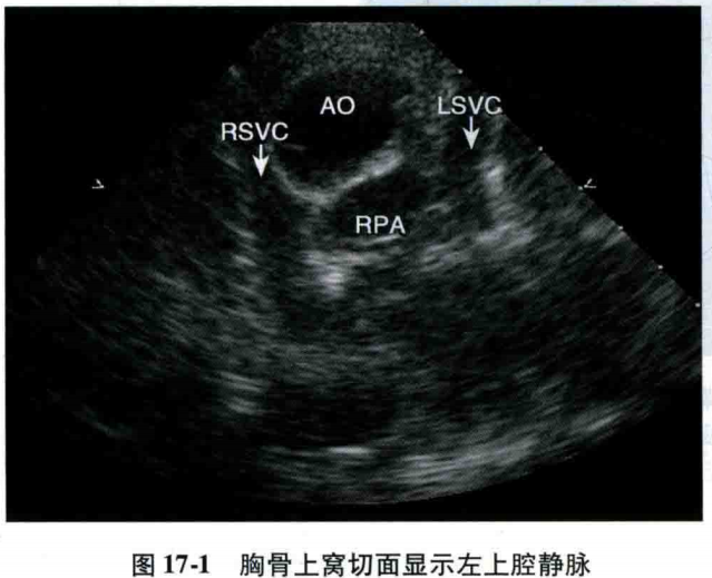 笔记分享永存左上腔静脉