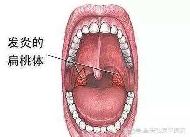 重庆弘医堂医院讲解扁桃体炎的危害有哪些