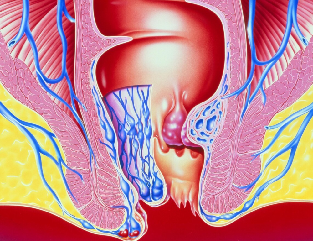 痔疮症状有哪些它如何治疗与预防一次性讲清楚痔疮的那些事