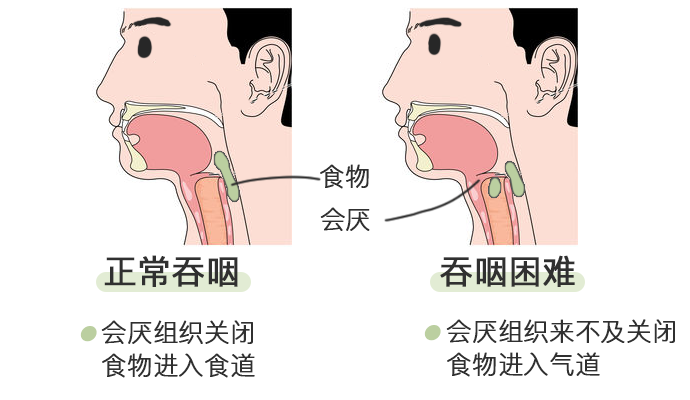 吞咽困难时:会厌组织来不及关闭,部分食物就会进入气管,结果就是被