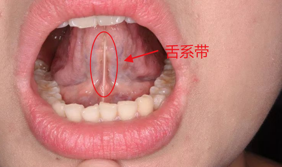 舌头形状不对奶奶瞒着家人给娃剪舌根一刀下去孩子再没开口说过话