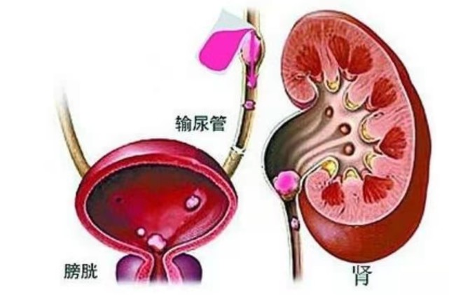 输尿管结石的临床表现有哪些?