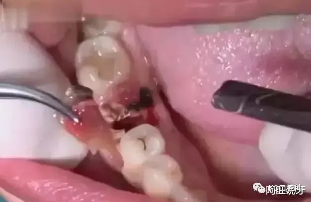 如果,你有了解过拔牙的全过程,它只是一个小case.