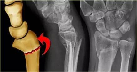 smith 骨折典型 colles 骨折,枪刺样,餐叉样畸形桡骨远端骨折,伴有
