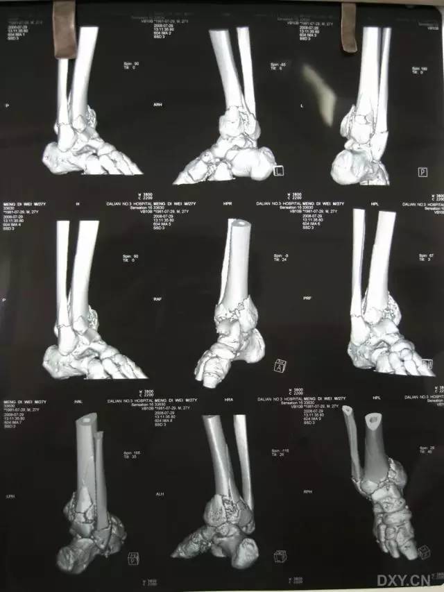 bosworth 骨折指踝关节骨折脱位,腓骨近端骨折片向后移位交锁于胫骨