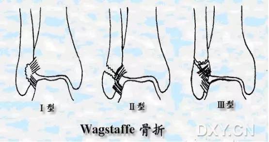 dupuytren 骨折脱位被列为一种少见的 lauge-hansen 旋前-外展型损伤