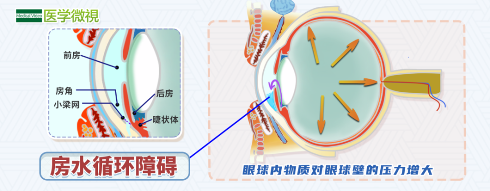 当房角受到阻塞, 房水循环发生障碍时,房水会积聚在眼内,造成 眼内压