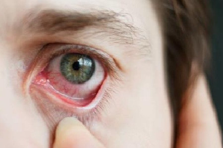 此外,由于眼部感染的潜伏期较长, 病程发展较慢.