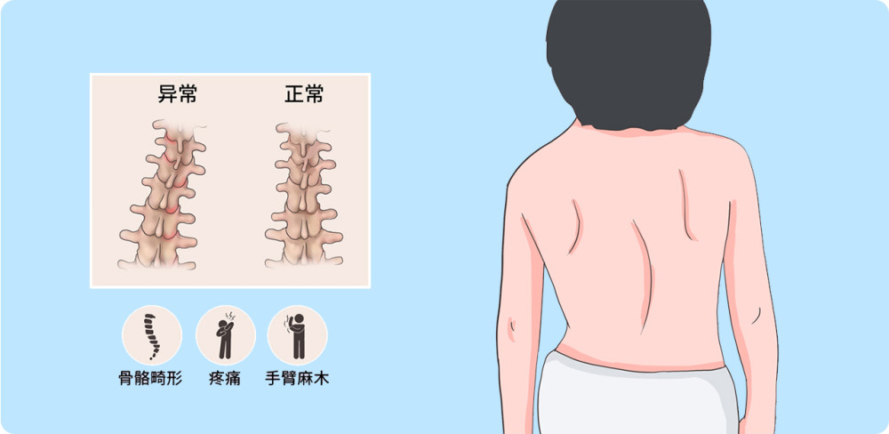 脑瘫与脊柱侧弯的关系您清楚吗
