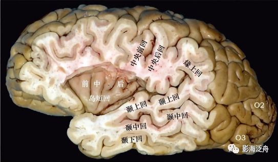 颞叶外侧面观:颞上沟(橙色)和颞下沟(黄色)将颞上回,颞中回和颞下回
