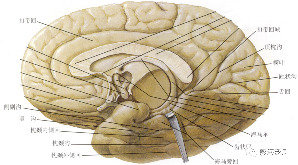 颞叶外侧面观(去掉表面的皮层:颞上回,颞中回和颞下回完全暴露出来.