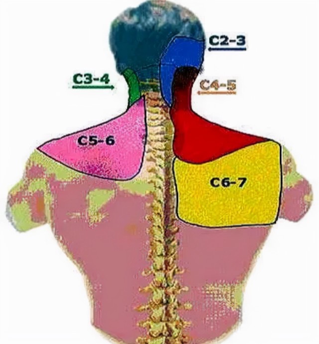 后背,肩胛骨区域疼痛是怎么回事?该如何应对?告诉您