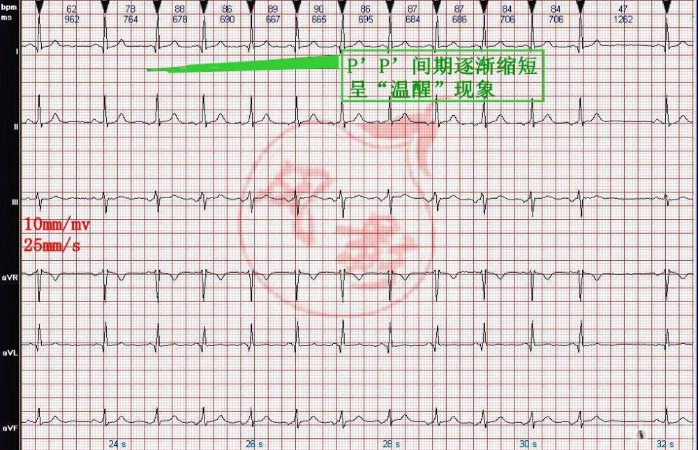 心电图图例分析5自律性房性心动过速