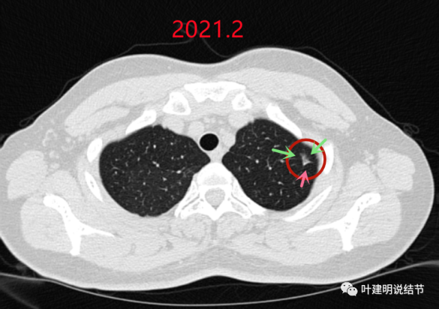 11.13:肺结节一会儿说大了,一会儿说小了!我的小心脏呀!