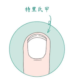 赶紧看看你的指甲,出现这种状况可能是生病了!