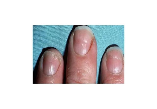 沟或者一个指甲上出现了多个小横沟可能就提示着某些疾病比如说"银屑