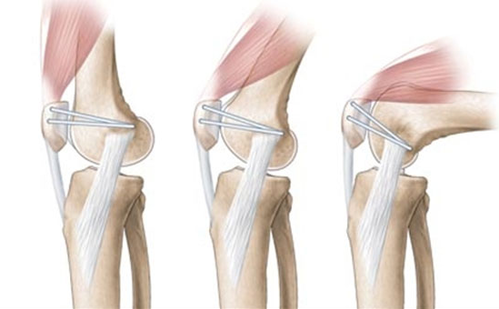 髌骨脱位术后屈膝困难的原因