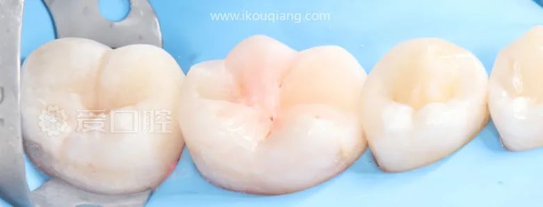 下颌第二前磨牙第二磨牙树脂充填1例