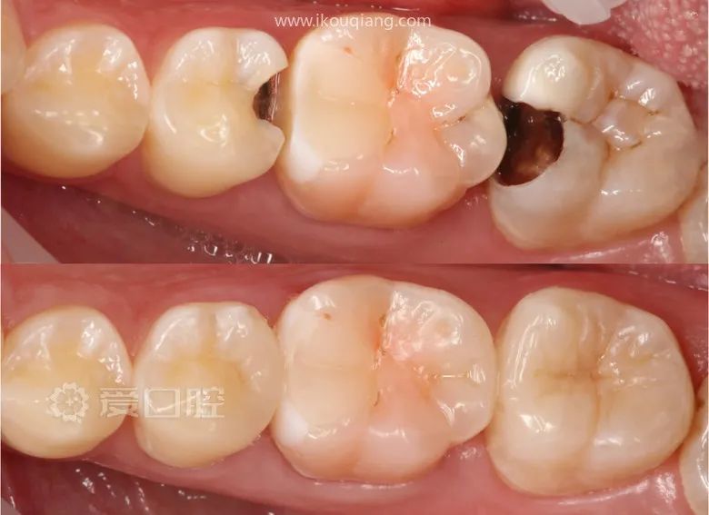 下颌第二前磨牙第二磨牙树脂充填1例