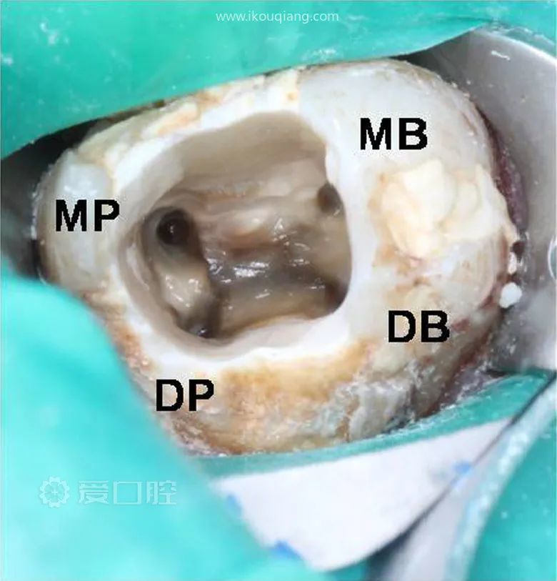 根管口分布法则:髓室底与髓室壁相比颜色较暗,根管口位于髓室底与髓室