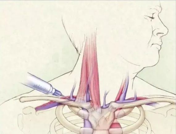 深静脉置管之锁骨下静脉穿刺,一文详解