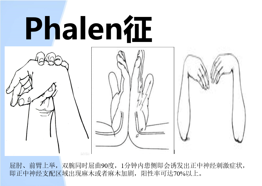 1 临床表现 2 tinel征阳性 3 phale