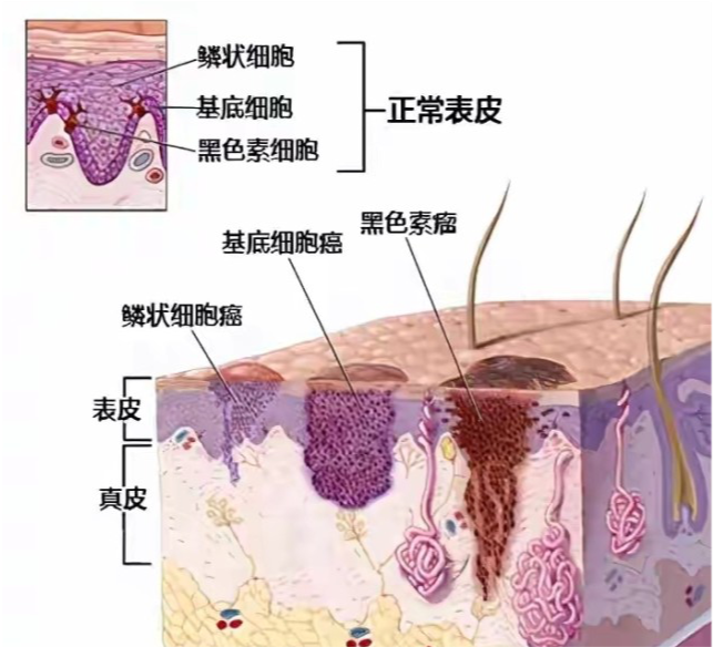 鳞状细胞癌和恶性黑色素瘤),这种皮肤病变都是由于皮肤免疫功能下降