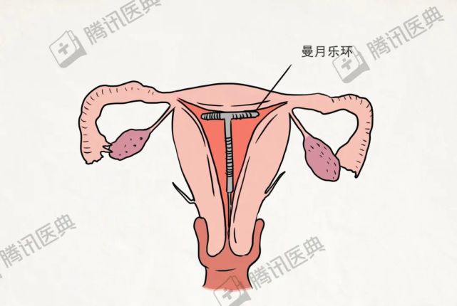 我们又在患者的宫腔内放置了曼月乐环.