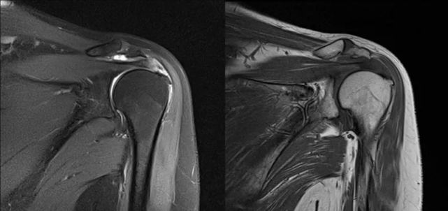 冈上肌mri目前是诊断肩袖疾病中最常用的检查,可以直观的观察肩袖肌腱