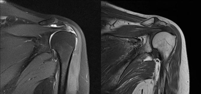 骨科精读|肩袖损伤的七大诊治要点,一文全掌握!