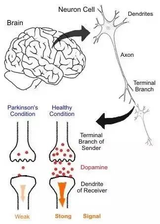 帕金森病突出的病理改变是中脑黑质多巴胺(dopamine da)能神经元的