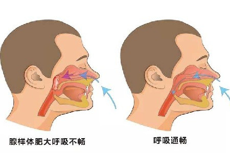 主要是因为腺样体肥大造成长期睡觉打呼噜,张口呼吸造成的,与睡觉打呼