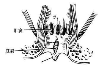 如何拯救肛窦炎