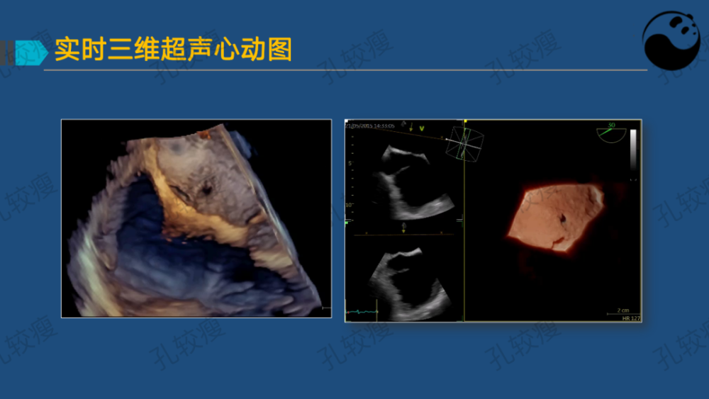 孔较瘦:卵圆孔未闭的超声心动图评估