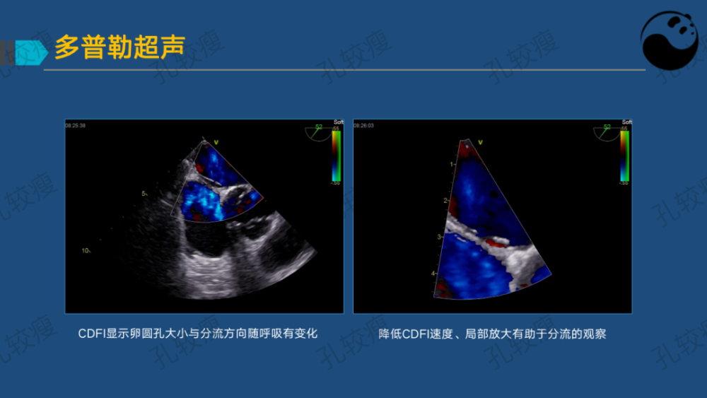 孔较瘦:卵圆孔未闭的超声心动图评估