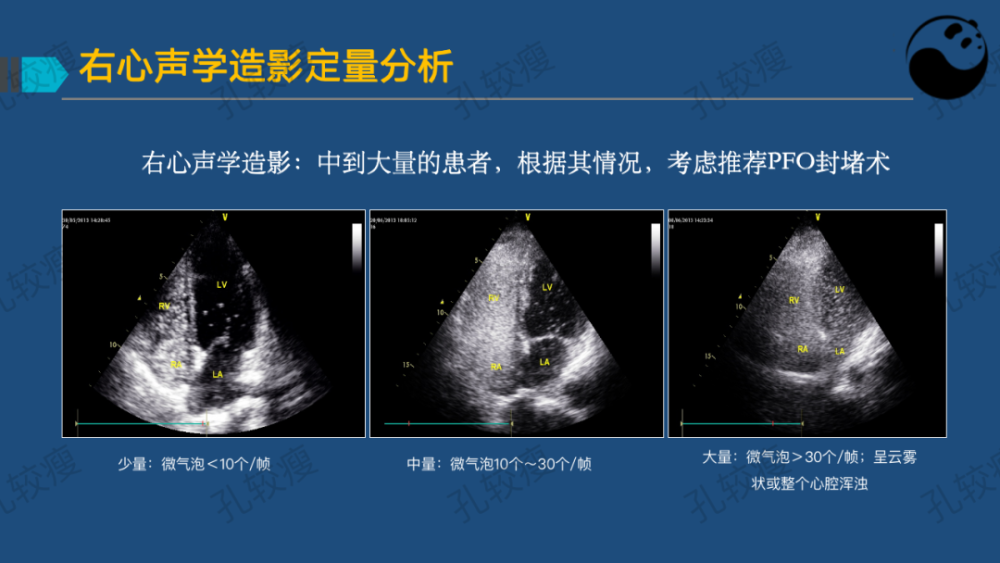 孔较瘦:卵圆孔未闭的超声心动图评估