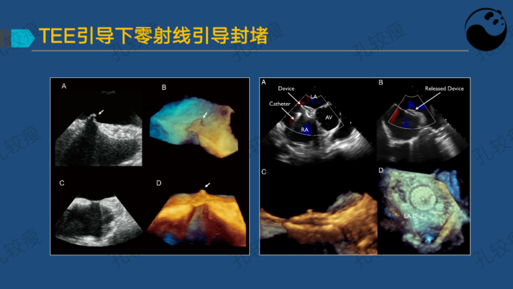 孔较瘦:卵圆孔未闭的超声心动图评估