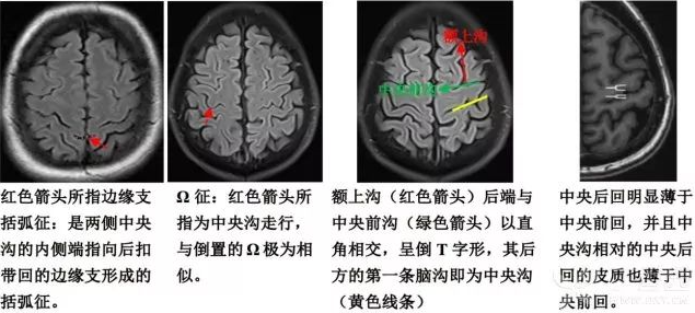 中央沟的四种征象头颅的大致影像解剖已经基本说清楚了,你是否都掌握