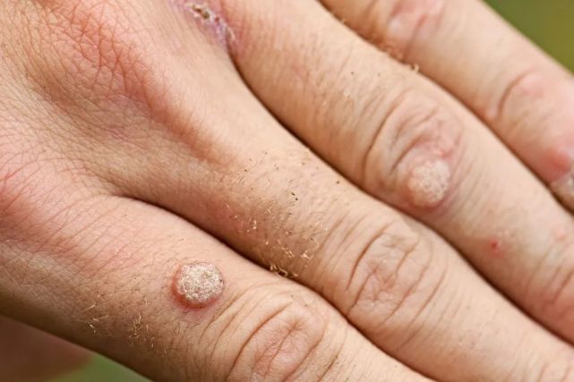身上这4种肉疙瘩,可能和hpv感染有关|hpv 感染|宫颈癌|尖锐湿疣