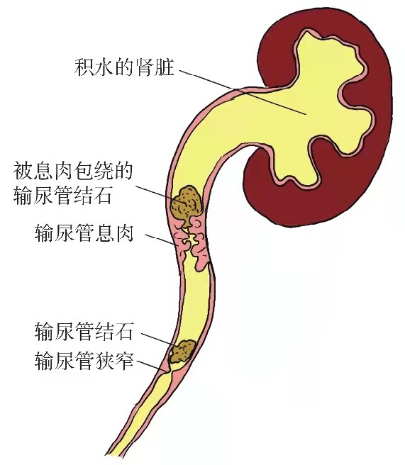 (5)输尿管狭窄:如果结石长期停留在输尿管某一部位无法排出,由于结石