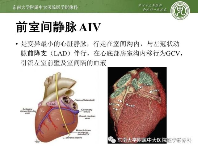 无顶冠状静脉窦综合征