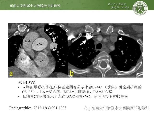 无顶冠状静脉窦综合征